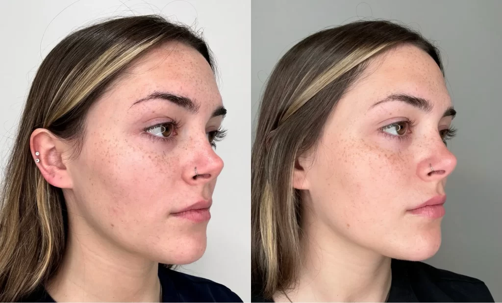 Microneedling before and after results at glowU Med Spa in Boca Raton