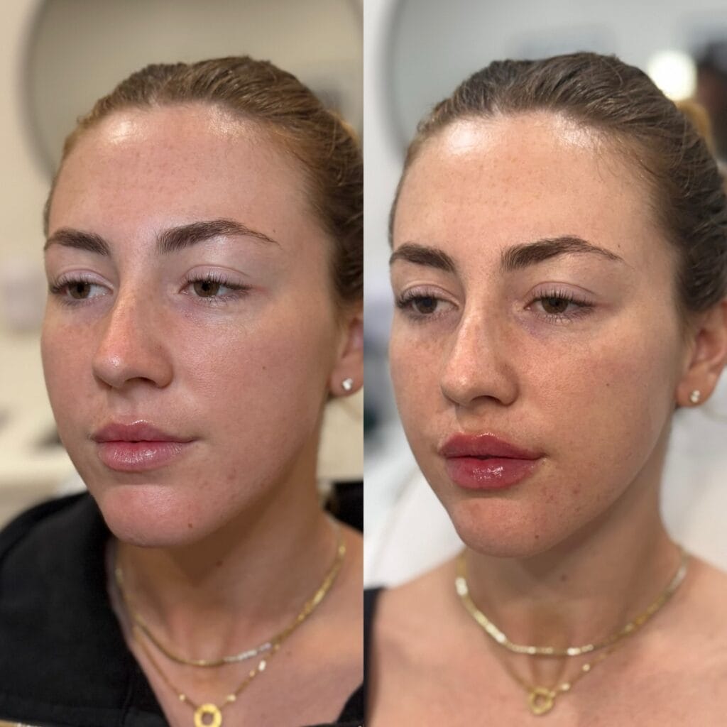 Biostimulator and HA filler before and after at glowU Med Spa in Boca Raton, FL