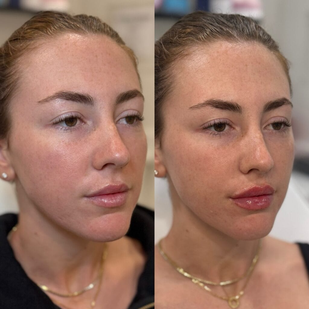 Biostimulator and HA filler before and after at glowU Med Spa in Boca Raton, FL