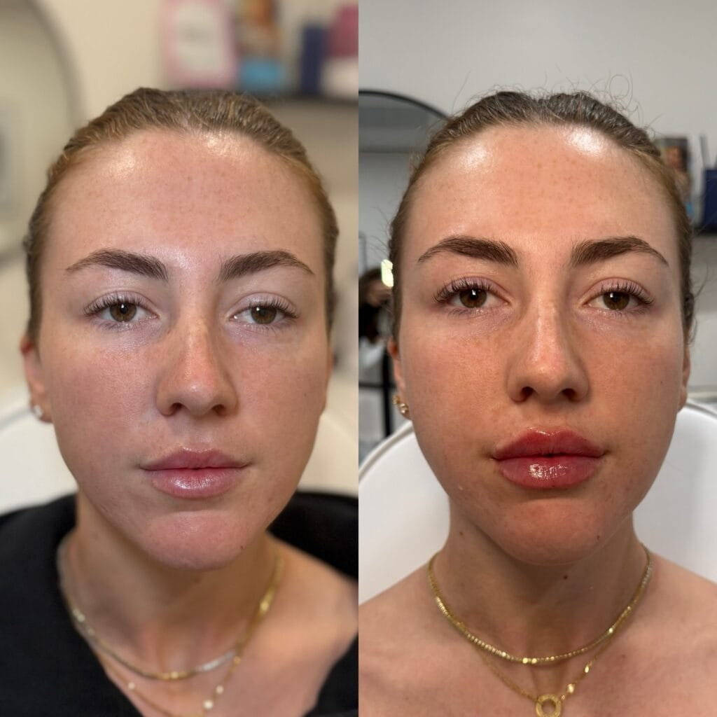 Biostimulator and HA filler before and after at glowU Med Spa in Boca Raton, FL