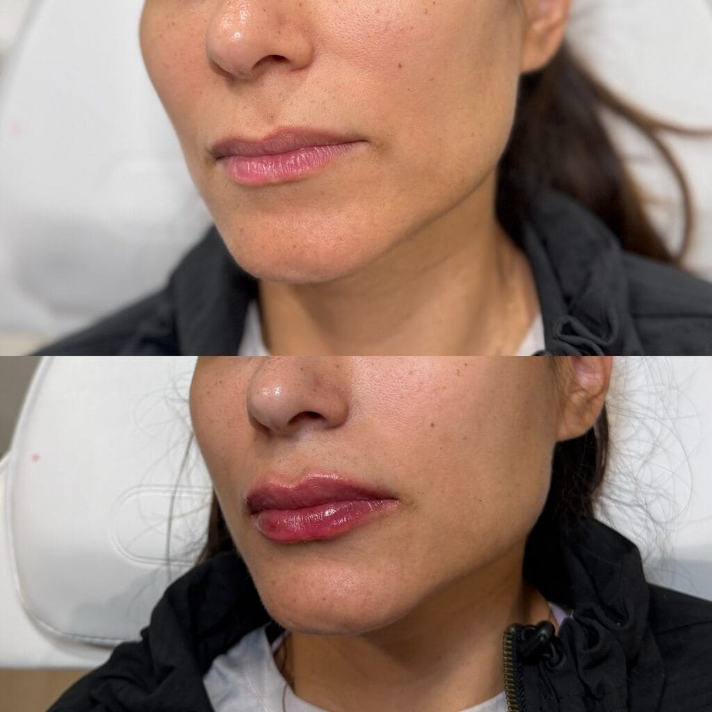 Dermal filler volume and definition before and after at glowU Med Spa in Boca Raton, FL