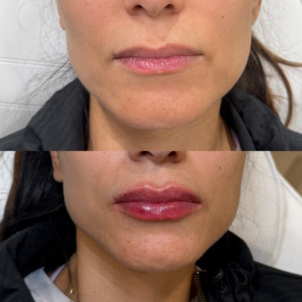 Dermal filler volume and definition before and after at glowU Med Spa in Boca Raton, FL