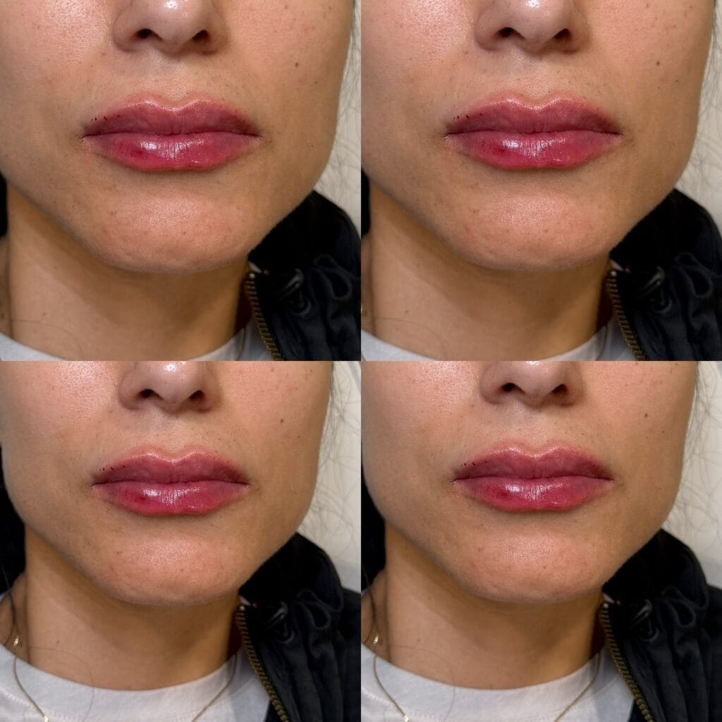 Dermal filler volume and definition before and after at glowU Med Spa in Boca Raton, FL