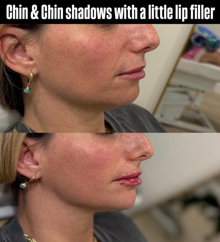 Dermal filler facial balancing before and after at glowU Med Spa in Boca Raton, FL