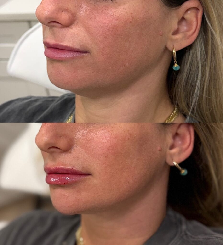 Dermal filler facial balancing before and after at glowU Med Spa in Boca Raton, FL