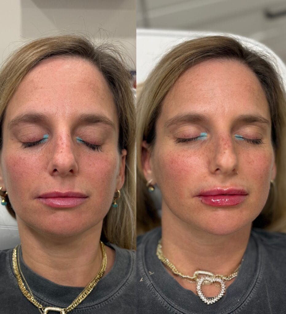 Dermal filler facial balancing before and after at glowU Med Spa in Boca Raton, FL