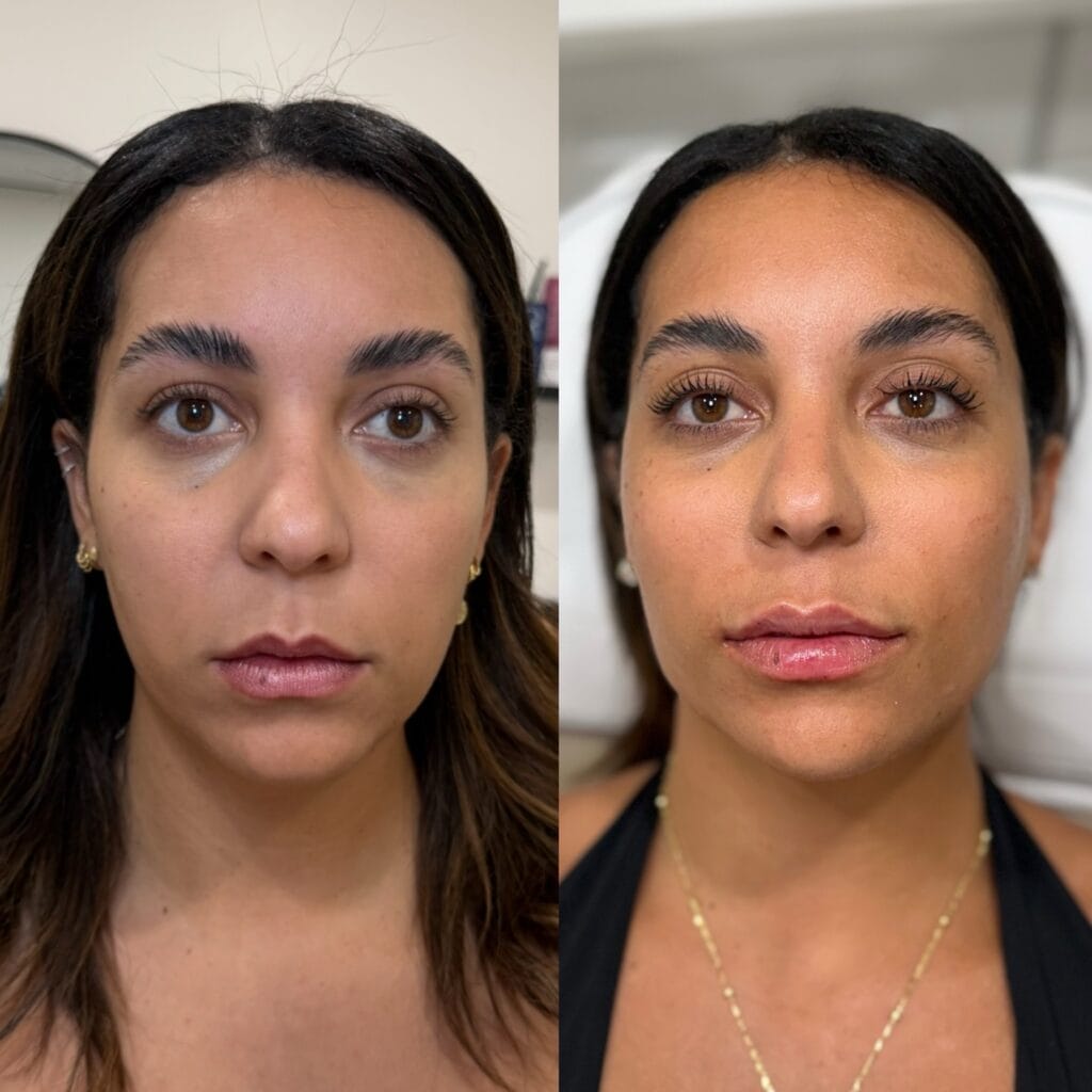 Full facial balancing before and after at glowU Med Spa in Boca Raton, FL