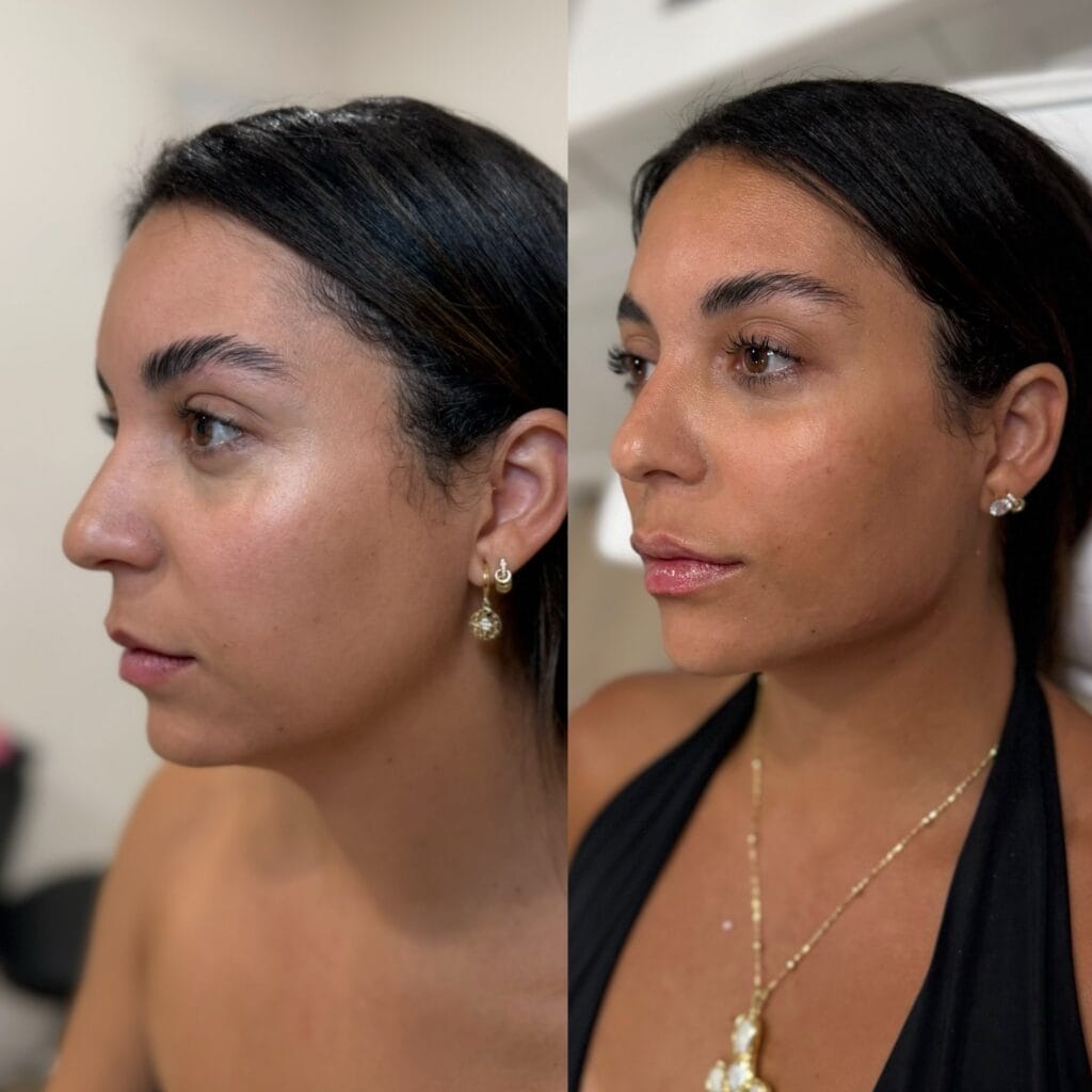Full facial balancing before and after at glowU Med Spa in Boca Raton, FL