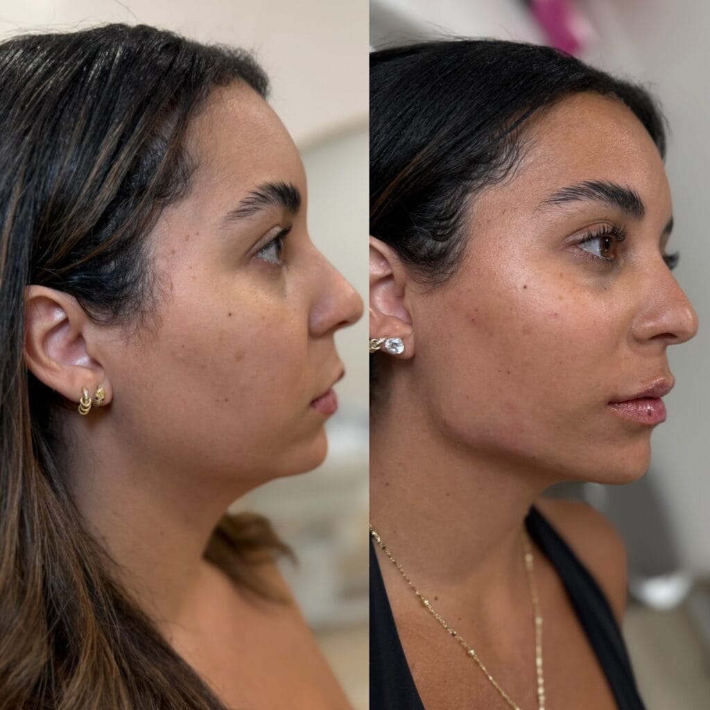 Full facial balancing before and after at glowU Med Spa in Boca Raton, FL