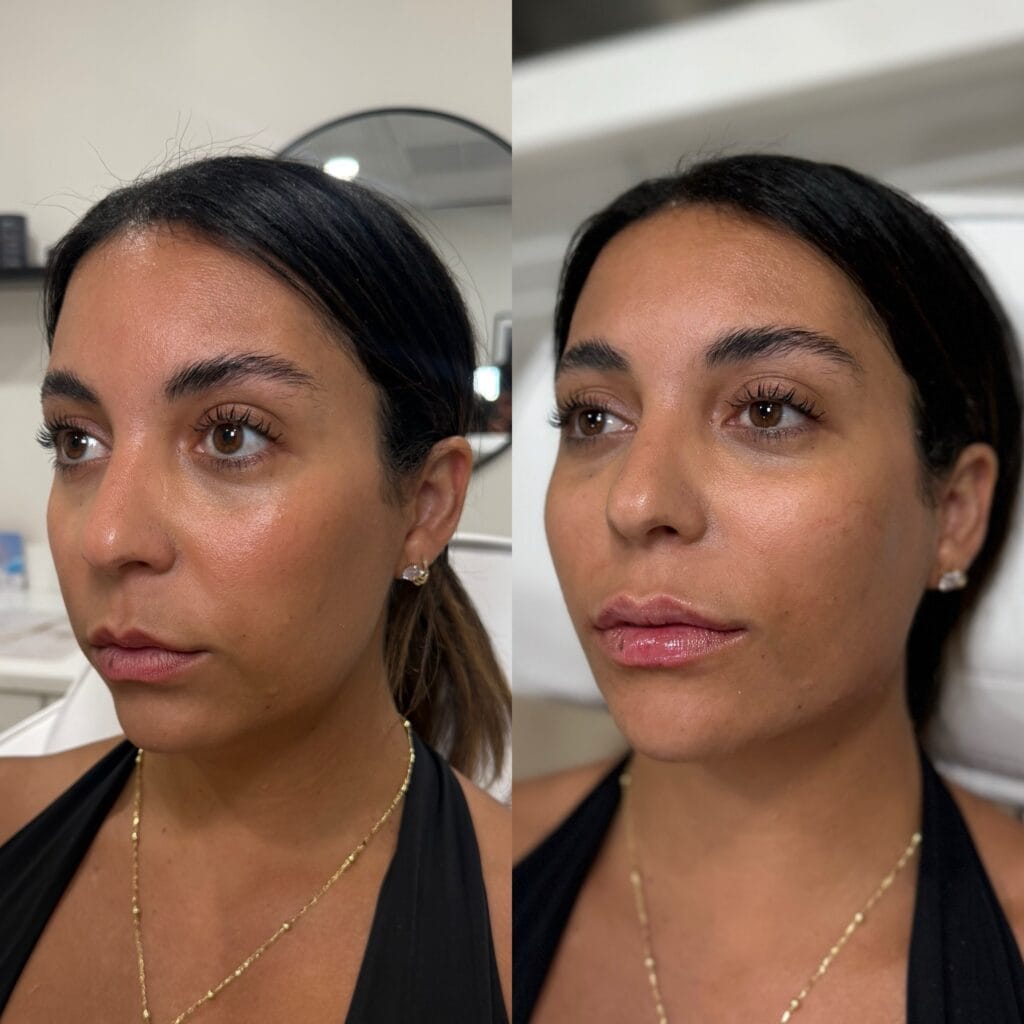 Full facial balancing before and after at glowU Med Spa in Boca Raton, FL