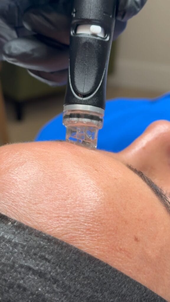 HydraFacial treatment at glowU Med Spa in Boca Raton, FL