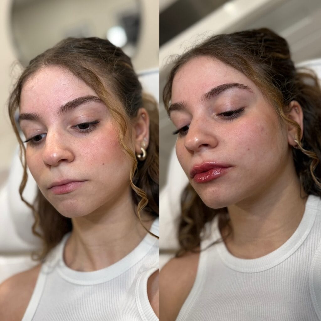 Lip filler before and after at glowU Med Spa in Boca Raton, FL