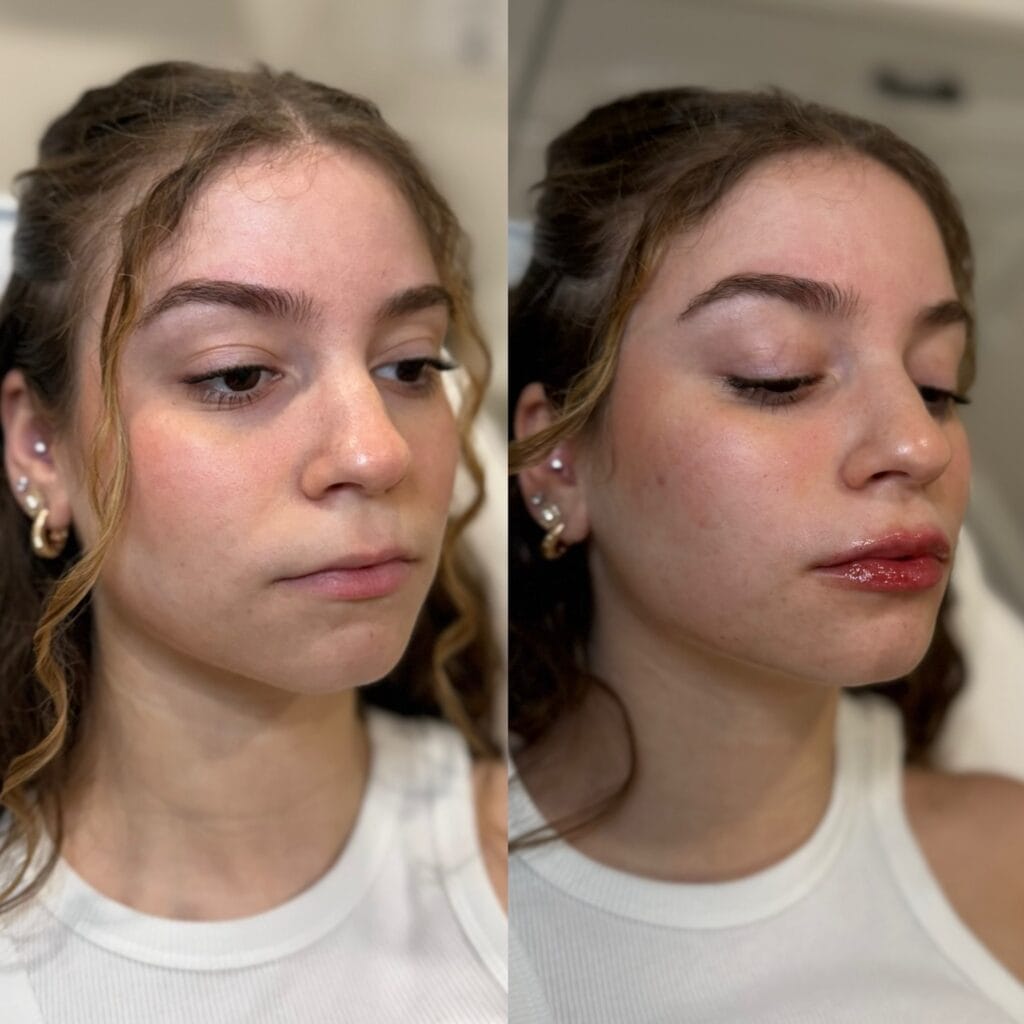 Lip filler before and after at glowU Med Spa in Boca Raton, FL