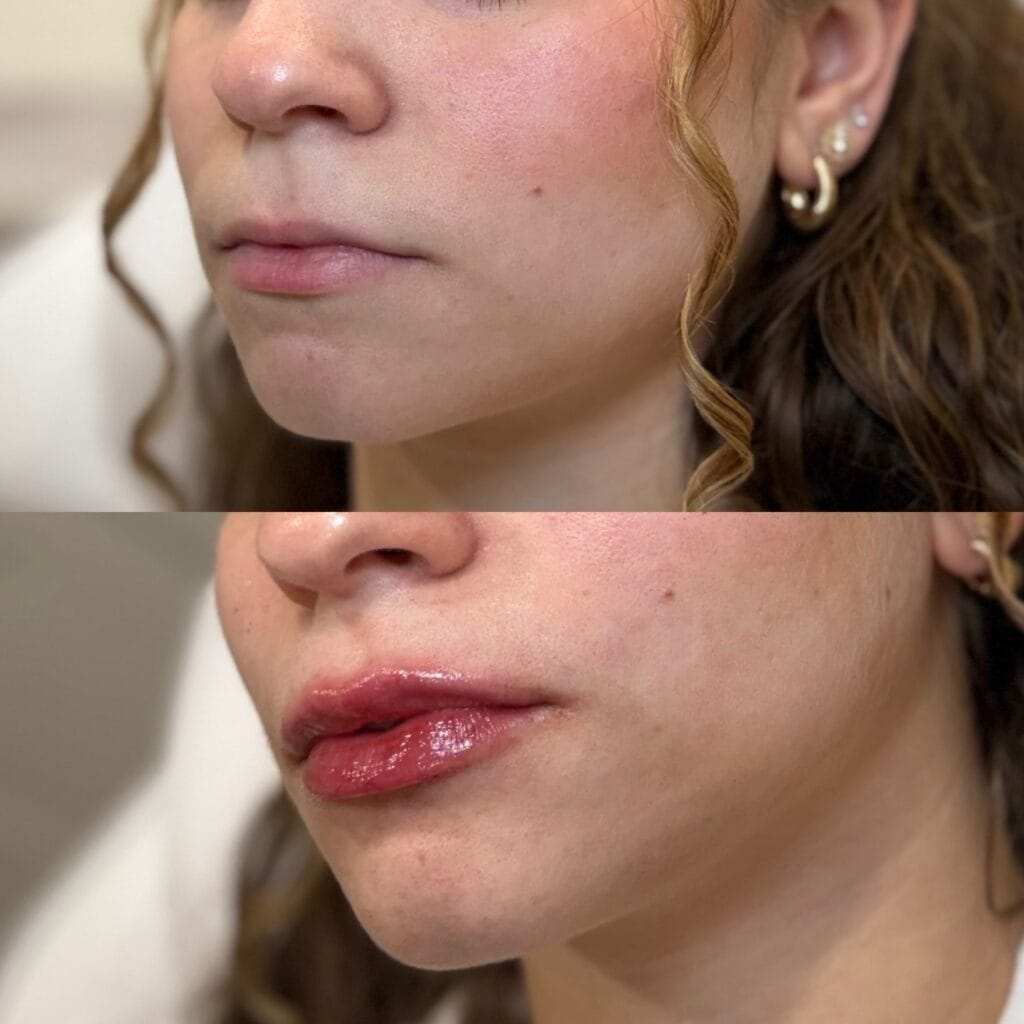 Lip filler before and after at glowU Med Spa in Boca Raton, FL