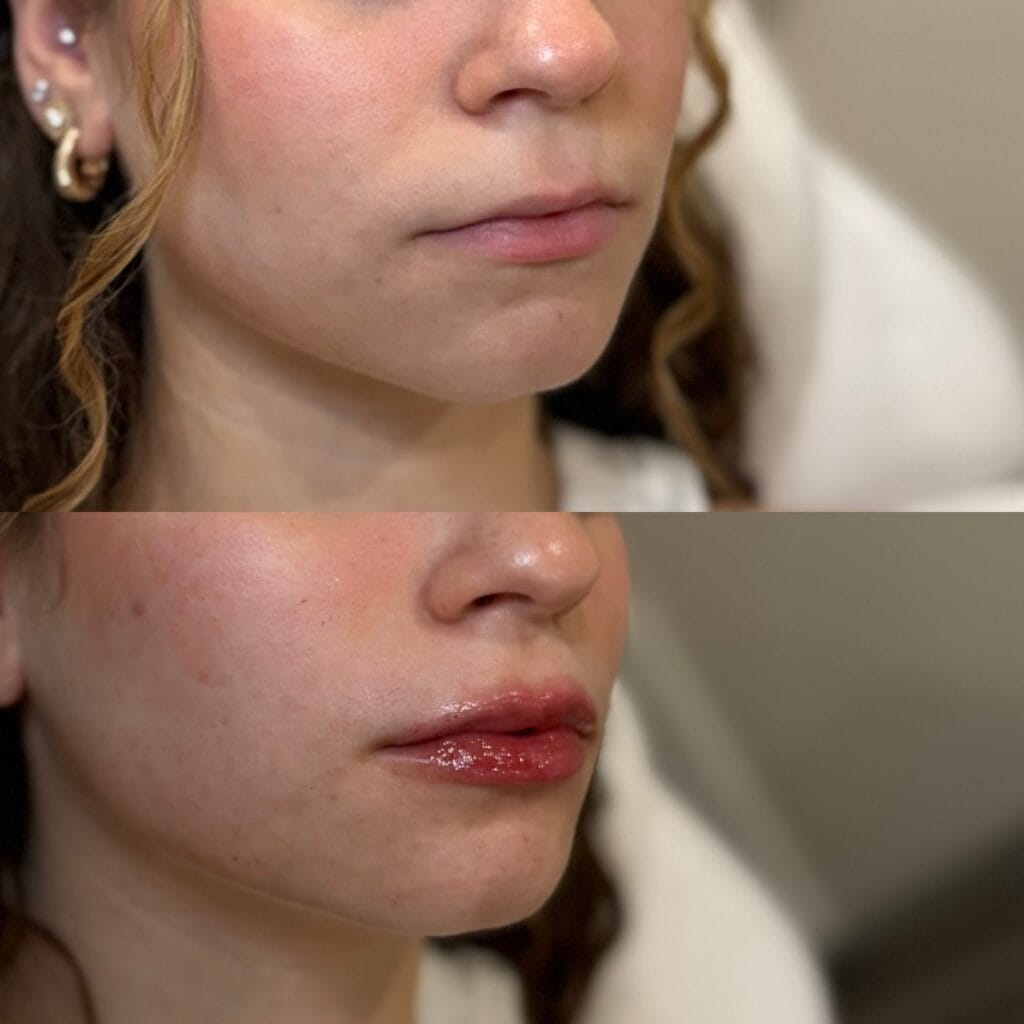 Lip filler before and after at glowU Med Spa in Boca Raton, FL