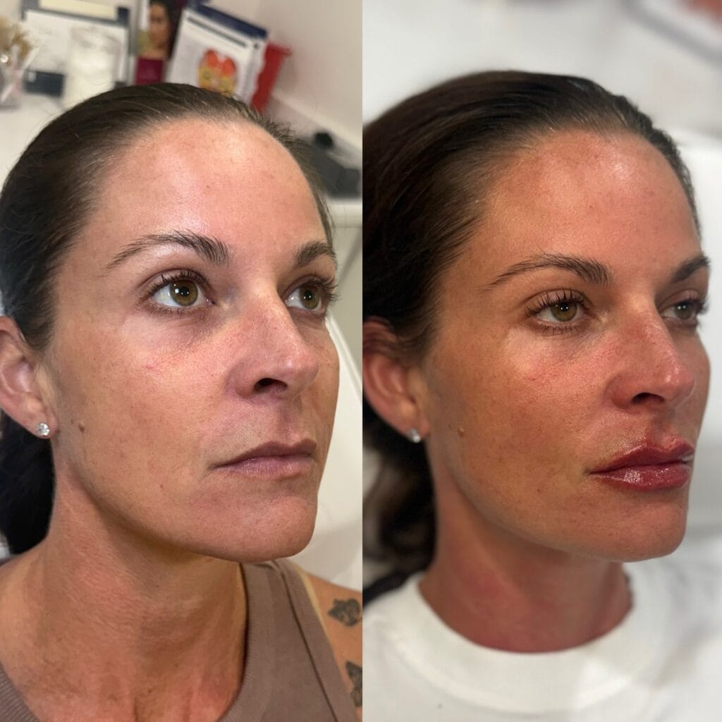 Natural dermal filler before and after at glowU Med Spa in Boca Raton, FL