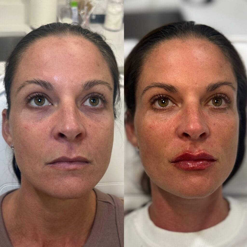 Natural dermal filler before and after at glowU Med Spa in Boca Raton, FL