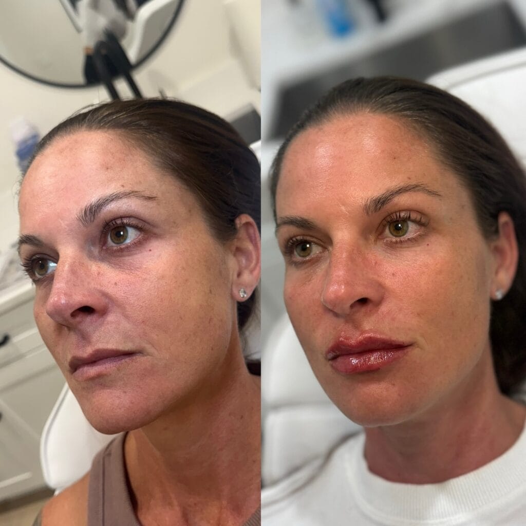 Natural dermal filler before and after at glowU Med Spa in Boca Raton, FL