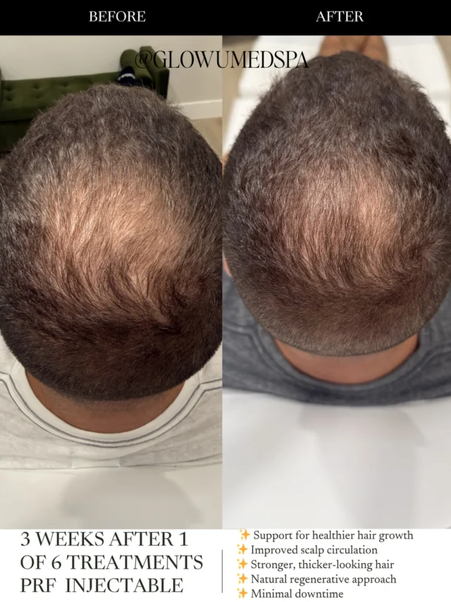 PRF Hair Restoration