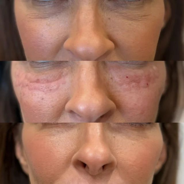 Salmon DNA polynucleotide skin rejuvenation before and after at glowU Med Spa in Boca Raton, FL