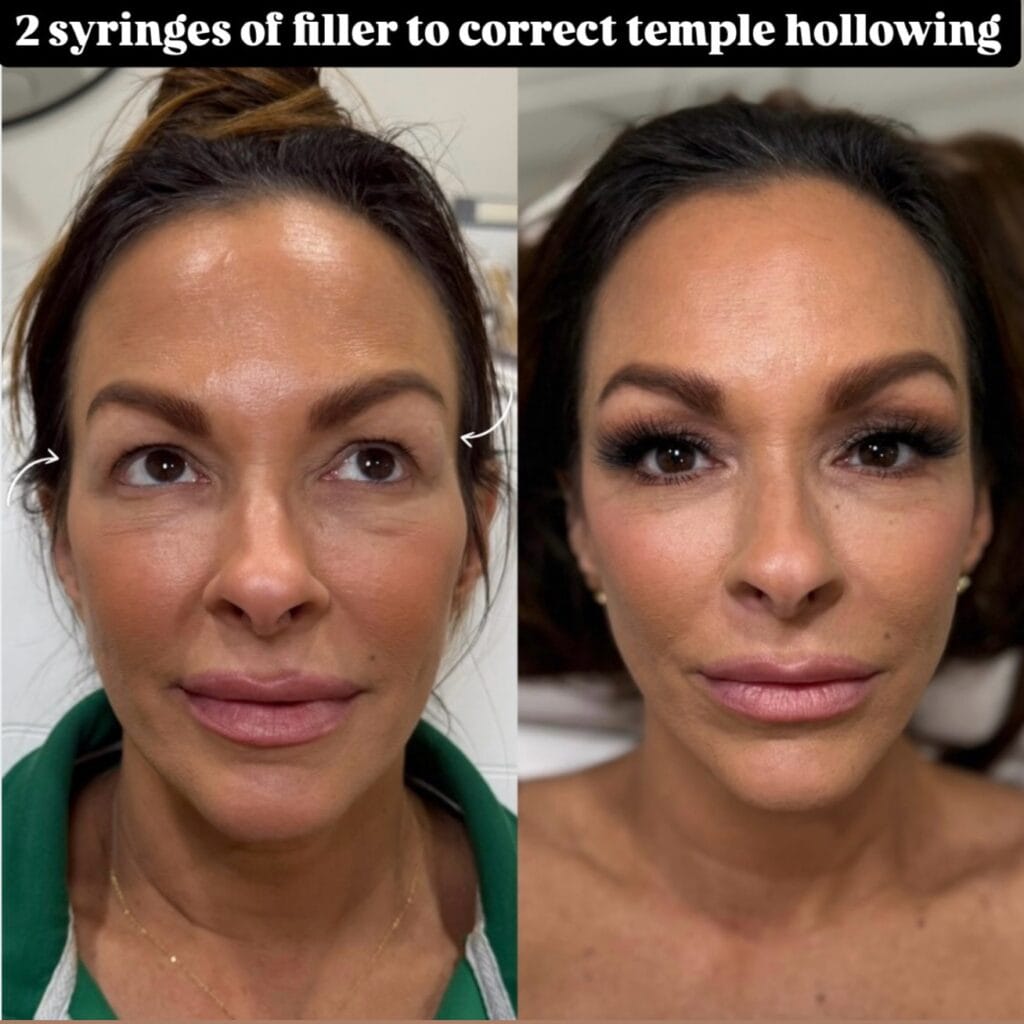 Temple filler before and after at glowU Med Spa in Boca Raton, FL