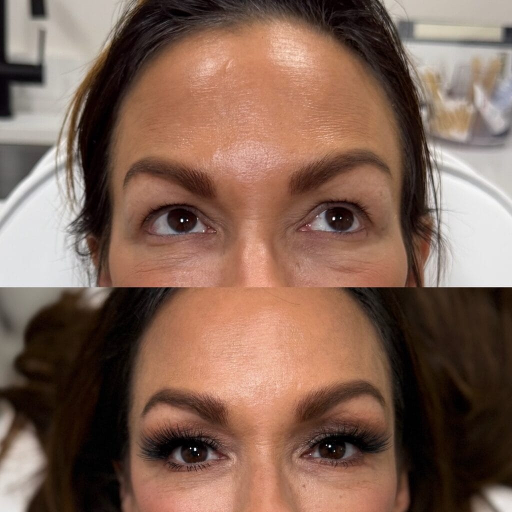 Temple filler before and after at glowU Med Spa in Boca Raton, FL