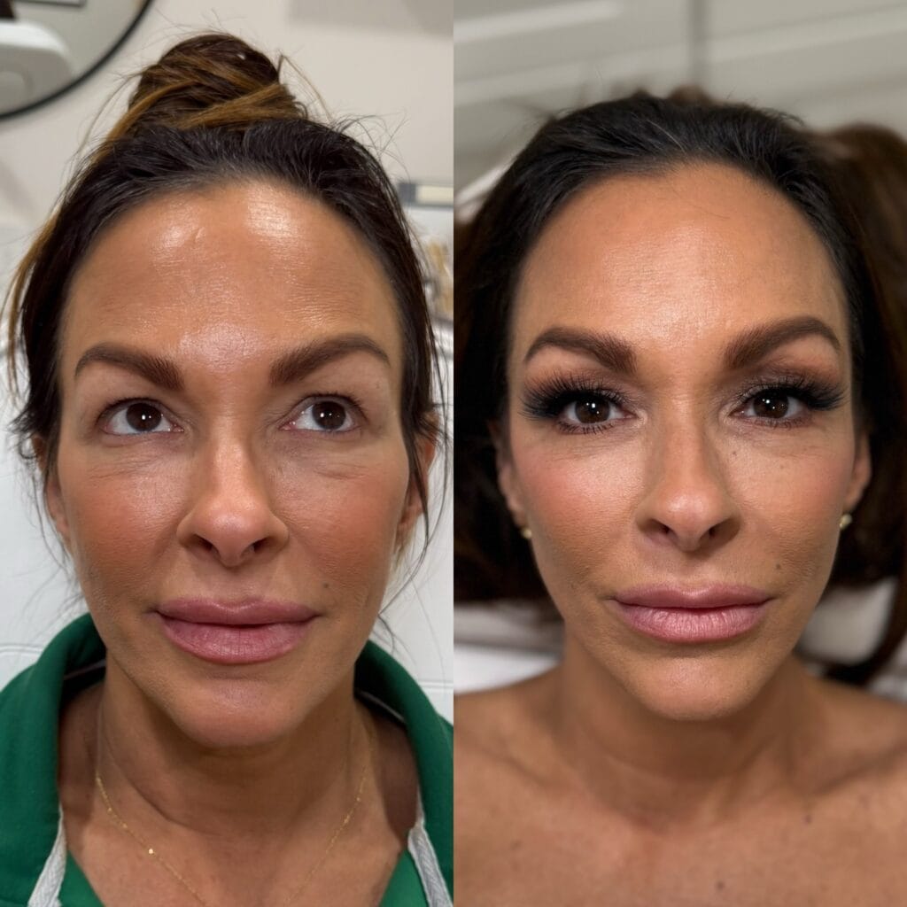 Temple filler before and after at glowU Med Spa in Boca Raton, FL